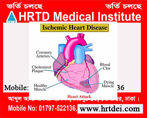 Ischemic Disease