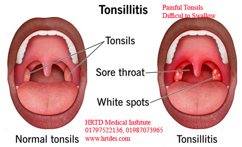 Tonsillitis