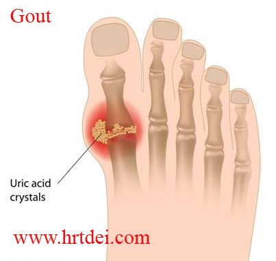 Gout