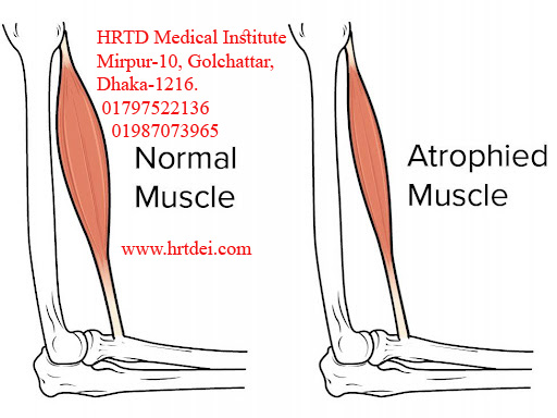 Muscle Atrophy