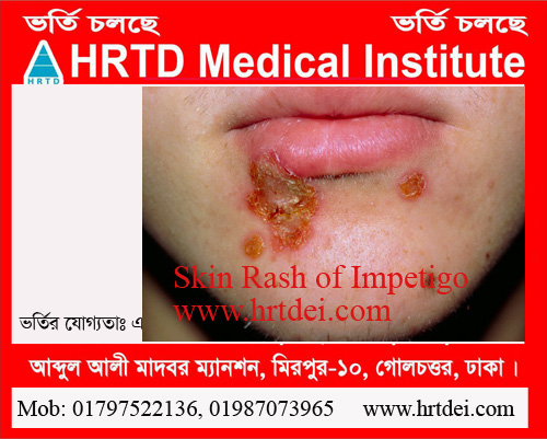 Skin Rash of Impetigo. 