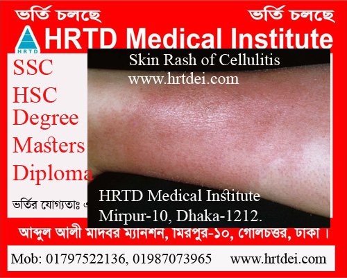 Skin Rash of Cellulitis. 