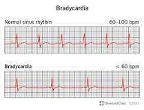 Bradycardia Management  3 image 1